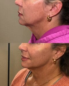 Before and after profile of woman's face.