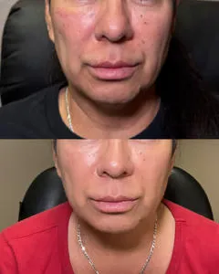 Before and after face treatment comparison.