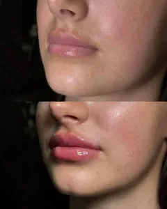 Before and after lip enhancement comparison.