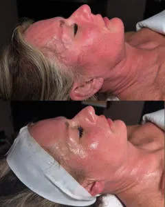 Facial treatment before and after comparison.