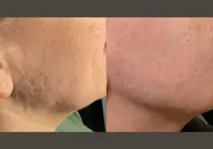 Before and after of facial skin treatment.